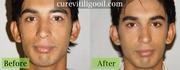 Cure Vitiligo